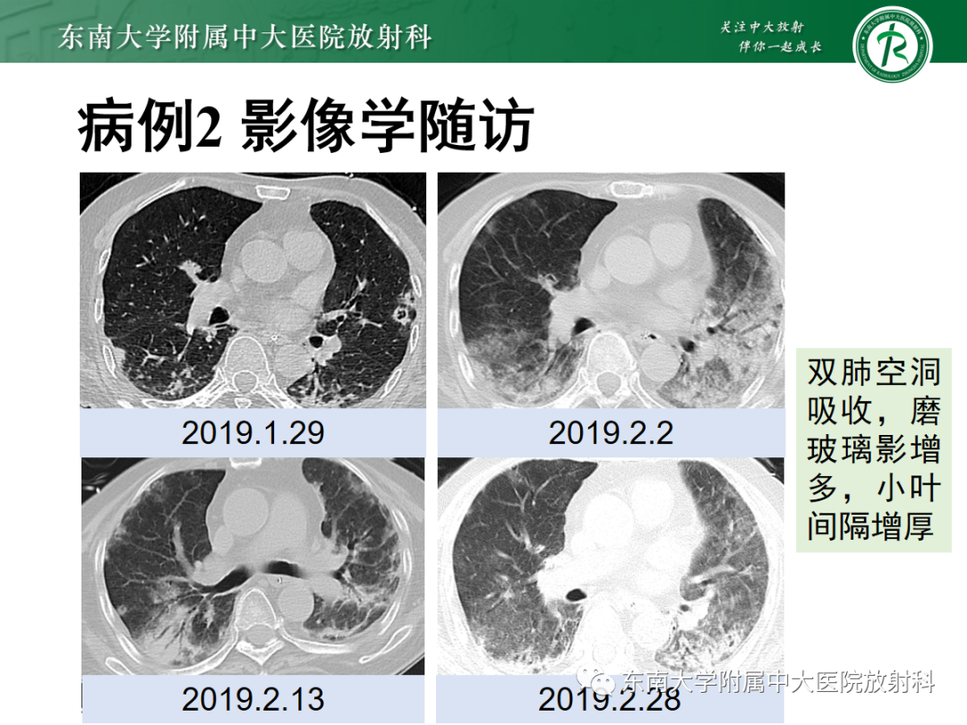 影像PPT - 【PPT】金黄色葡萄球菌肺炎-28 影像PPT - 【PPT】金黄色葡萄球菌肺炎-28