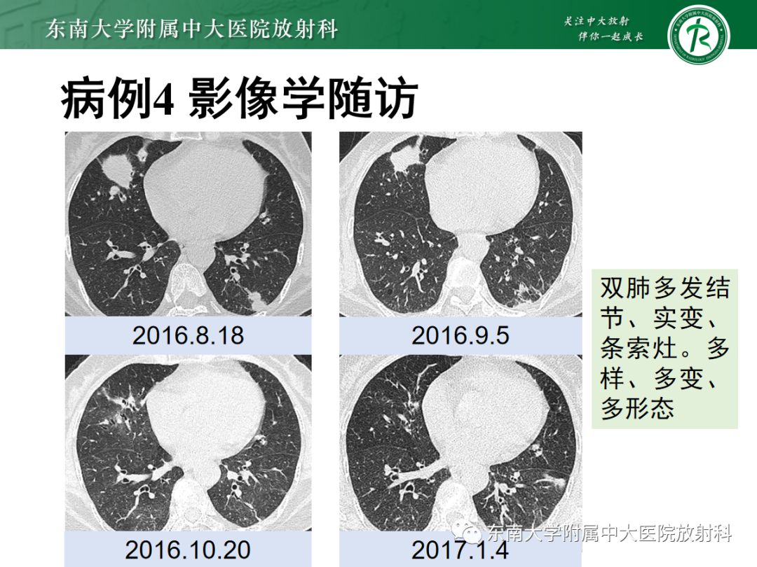 影像PPT - 【PPT】金黄色葡萄球菌肺炎-44 影像PPT - 【PPT】金黄色葡萄球菌肺炎-44
