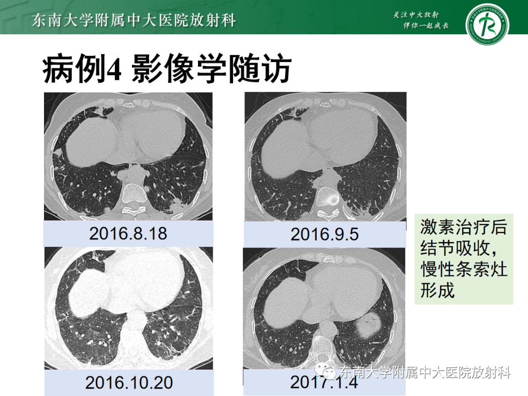 影像PPT - 【PPT】金黄色葡萄球菌肺炎-45 影像PPT - 【PPT】金黄色葡萄球菌肺炎-45