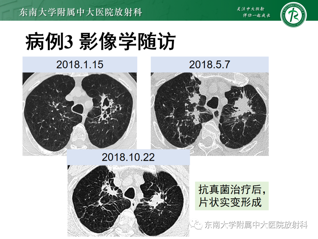 影像PPT - 【PPT】金黄色葡萄球菌肺炎-34 影像PPT - 【PPT】金黄色葡萄球菌肺炎-34