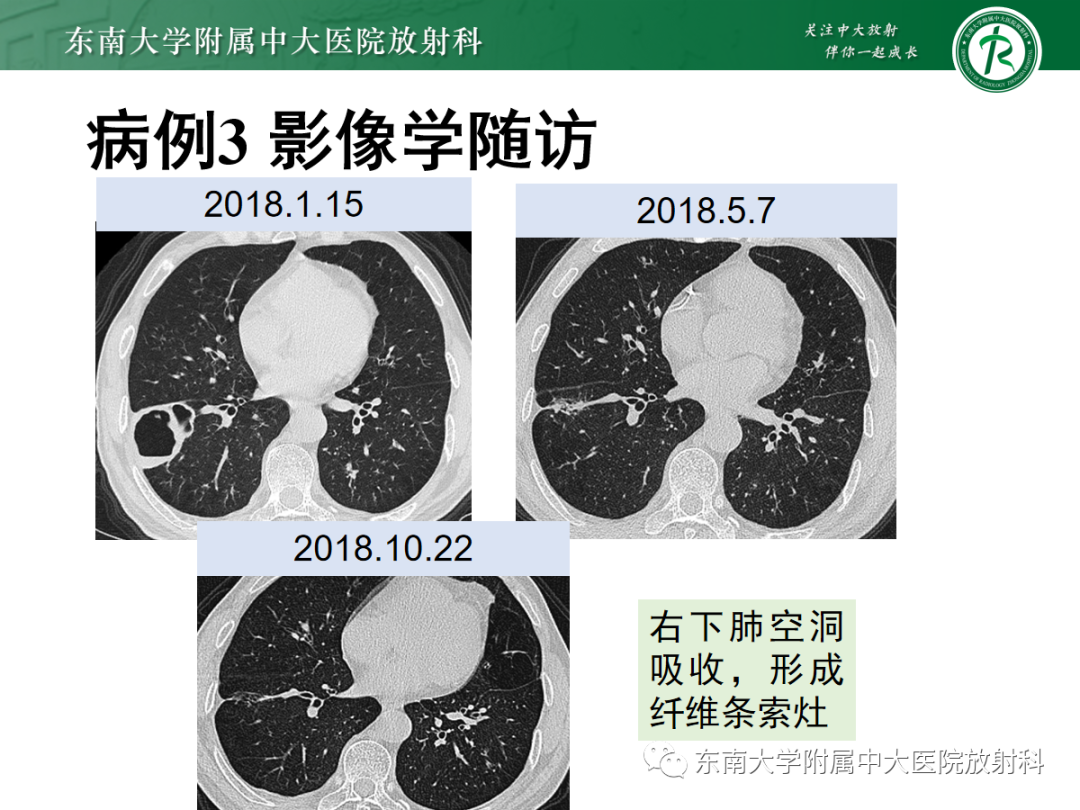 影像PPT - 【PPT】金黄色葡萄球菌肺炎-35 影像PPT - 【PPT】金黄色葡萄球菌肺炎-35