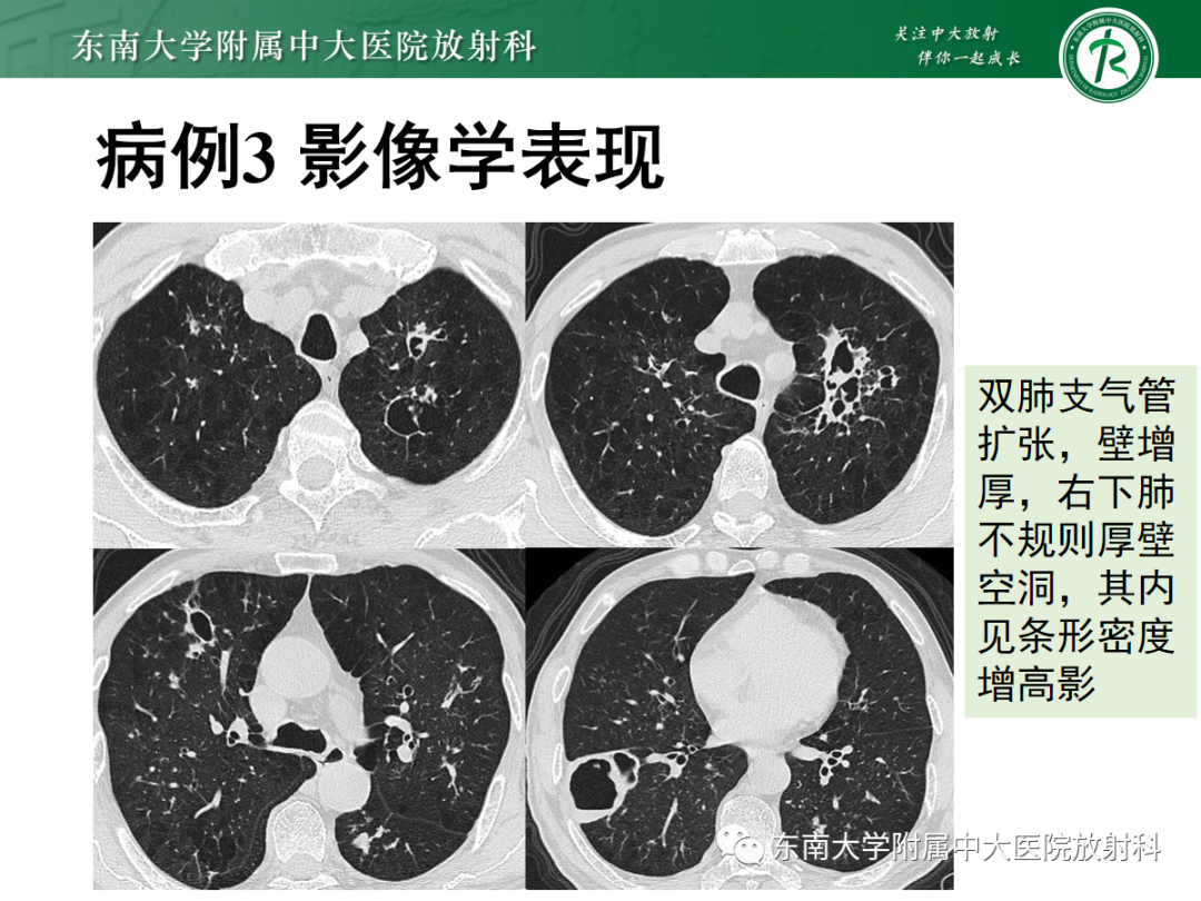 影像PPT - 【PPT】金黄色葡萄球菌肺炎-33 影像PPT - 【PPT】金黄色葡萄球菌肺炎-33