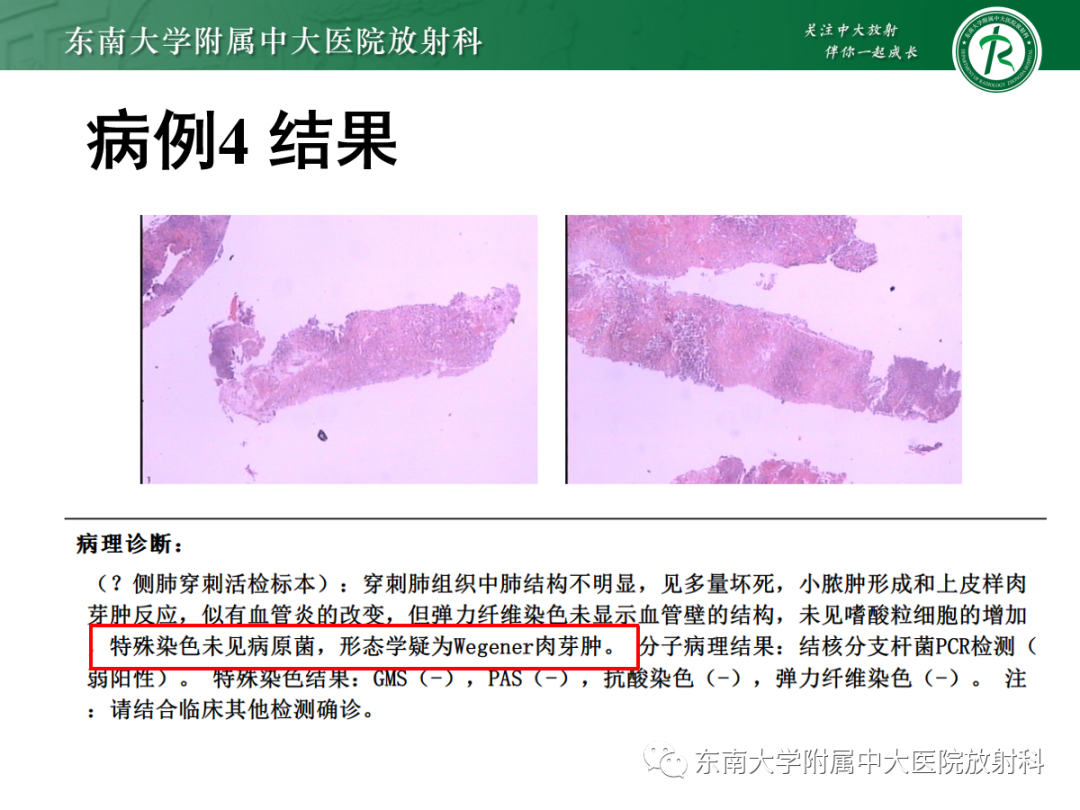 影像PPT - 【PPT】金黄色葡萄球菌肺炎-46 影像PPT - 【PPT】金黄色葡萄球菌肺炎-46