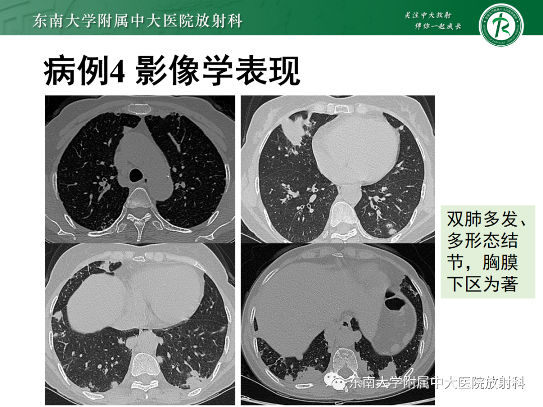 影像PPT - 【PPT】金黄色葡萄球菌肺炎-43 影像PPT - 【PPT】金黄色葡萄球菌肺炎-43