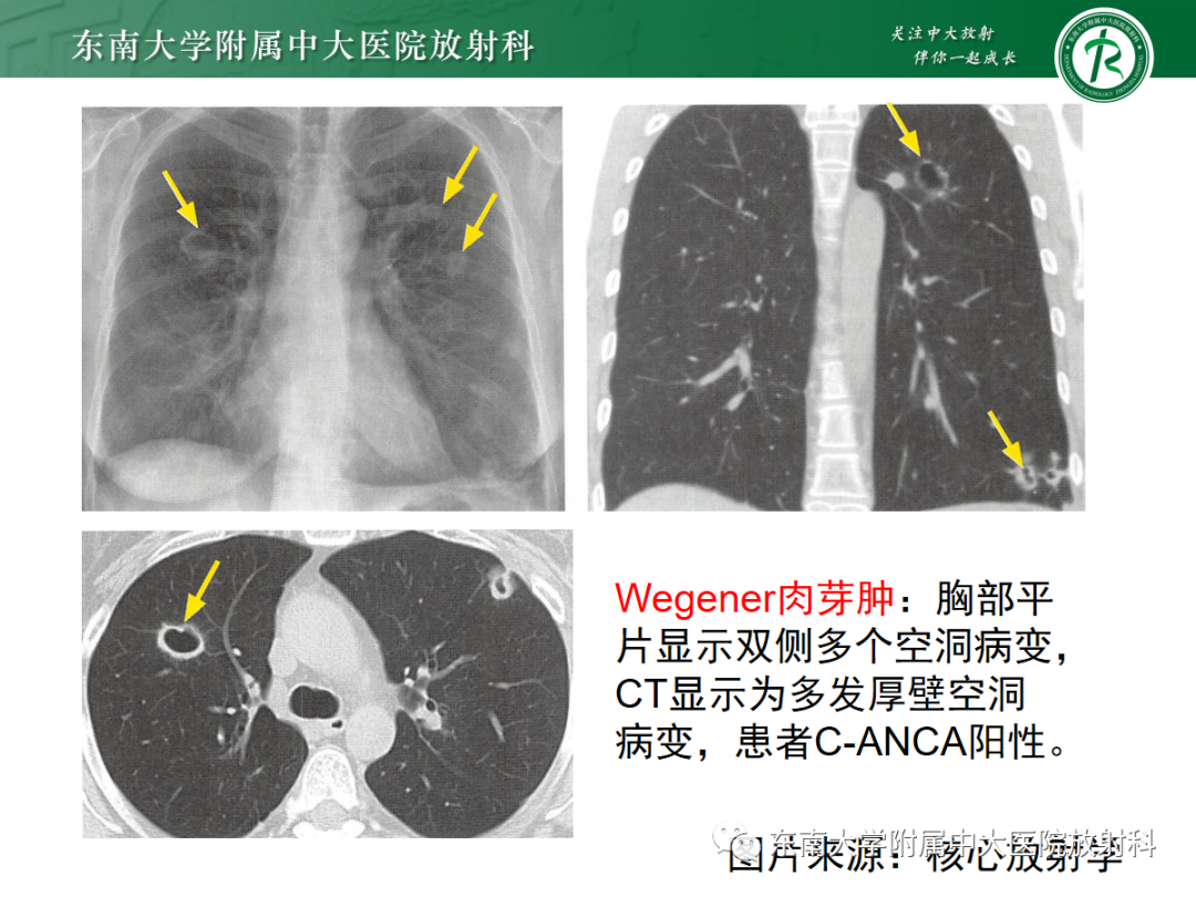 影像PPT - 【PPT】金黄色葡萄球菌肺炎-40 影像PPT - 【PPT】金黄色葡萄球菌肺炎-40