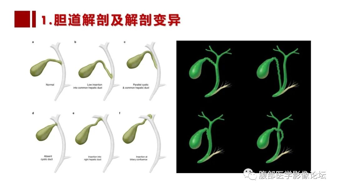 影像PPT - 【PPT】普美显胆管MR成像及其临床应用-26