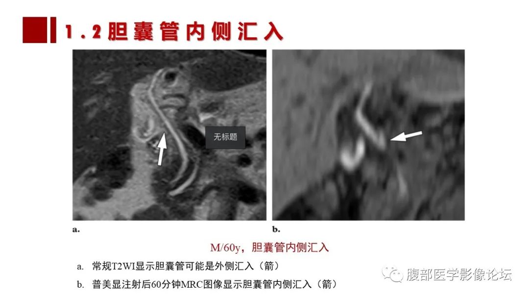 影像PPT - 【PPT】普美显胆管MR成像及其临床应用-28
