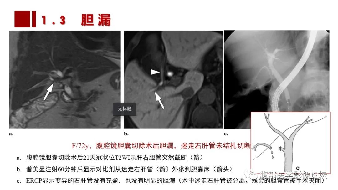 影像PPT - 【PPT】普美显胆管MR成像及其临床应用-29