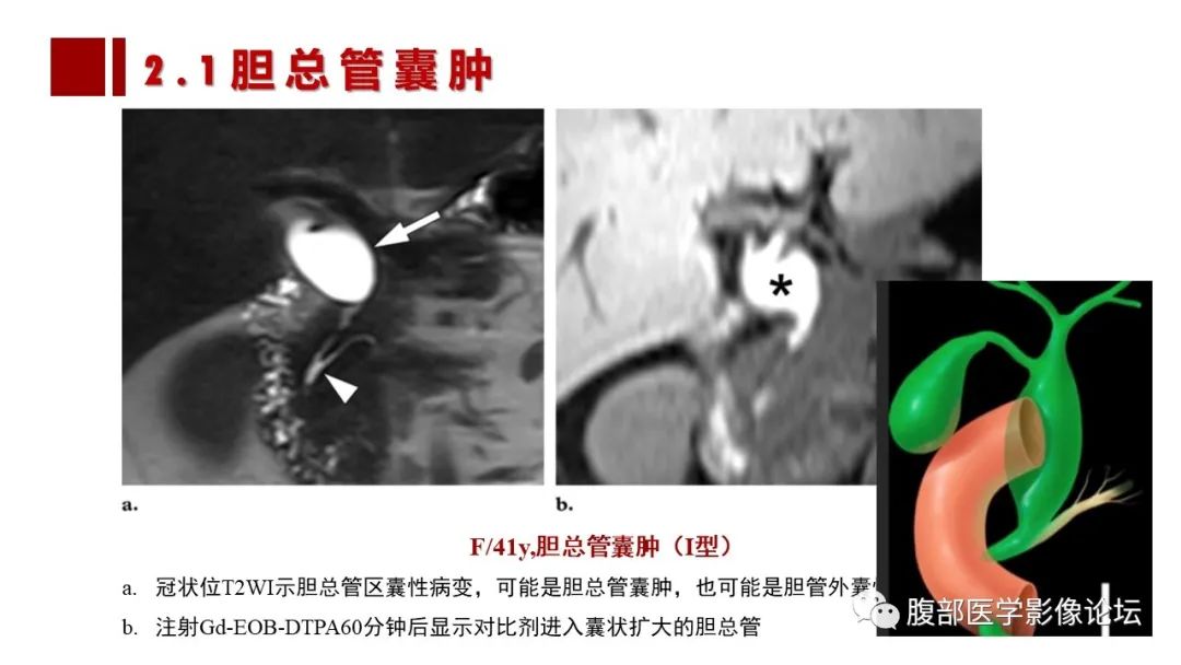 影像PPT - 【PPT】普美显胆管MR成像及其临床应用-31