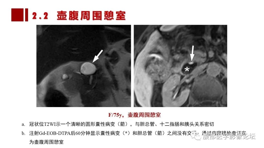 影像PPT - 【PPT】普美显胆管MR成像及其临床应用-32