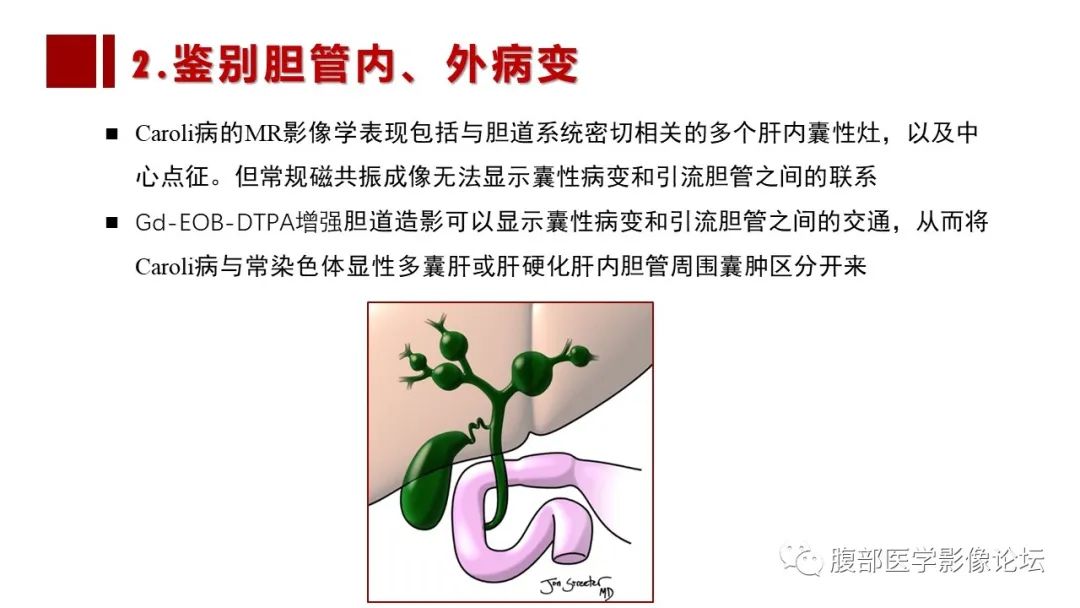 影像PPT - 【PPT】普美显胆管MR成像及其临床应用-33