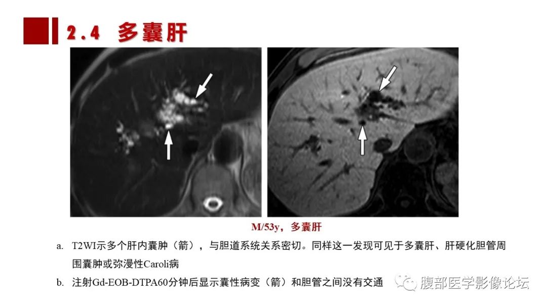 影像PPT - 【PPT】普美显胆管MR成像及其临床应用-35