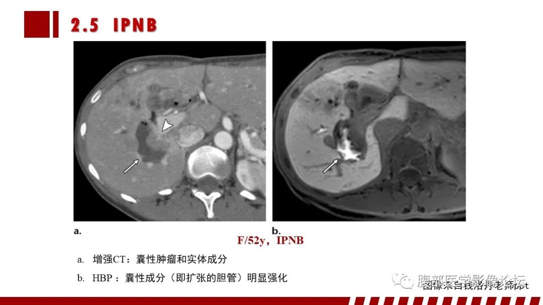 影像PPT - 【PPT】普美显胆管MR成像及其临床应用-36