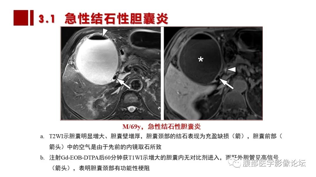影像PPT - 【PPT】普美显胆管MR成像及其临床应用-39