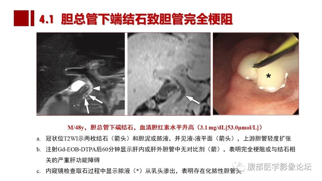 影像PPT - 【PPT】普美显胆管MR成像及其临床应用-41