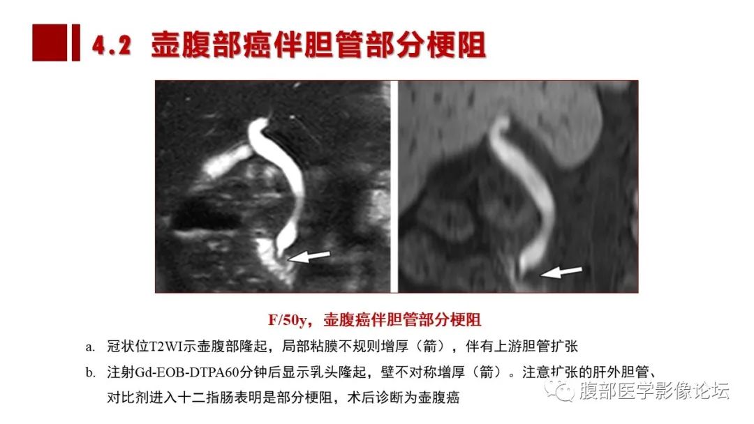 影像PPT - 【PPT】普美显胆管MR成像及其临床应用-42