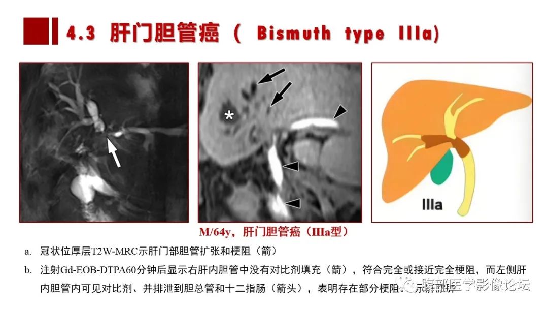 影像PPT - 【PPT】普美显胆管MR成像及其临床应用-44