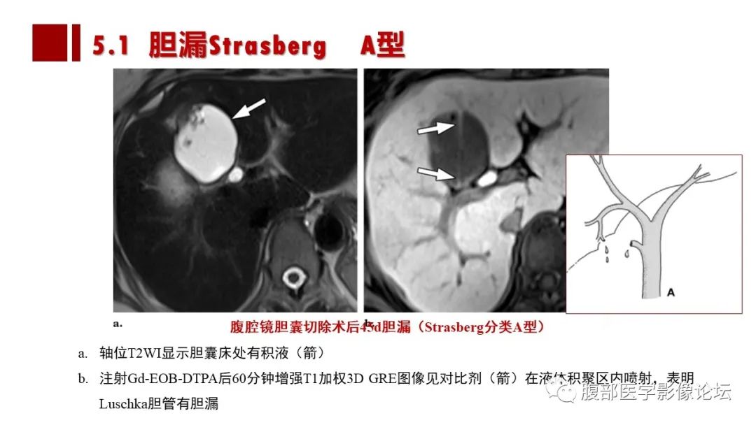 影像PPT - 【PPT】普美显胆管MR成像及其临床应用-50