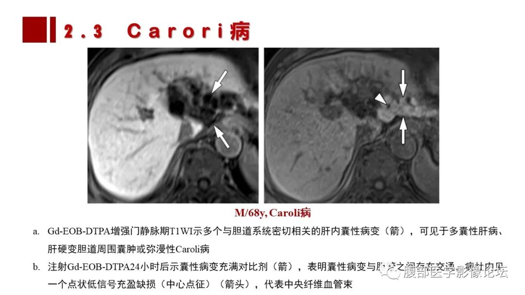 影像PPT - 【PPT】普美显胆管MR成像及其临床应用-34