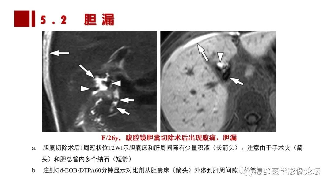 影像PPT - 【PPT】普美显胆管MR成像及其临床应用-51