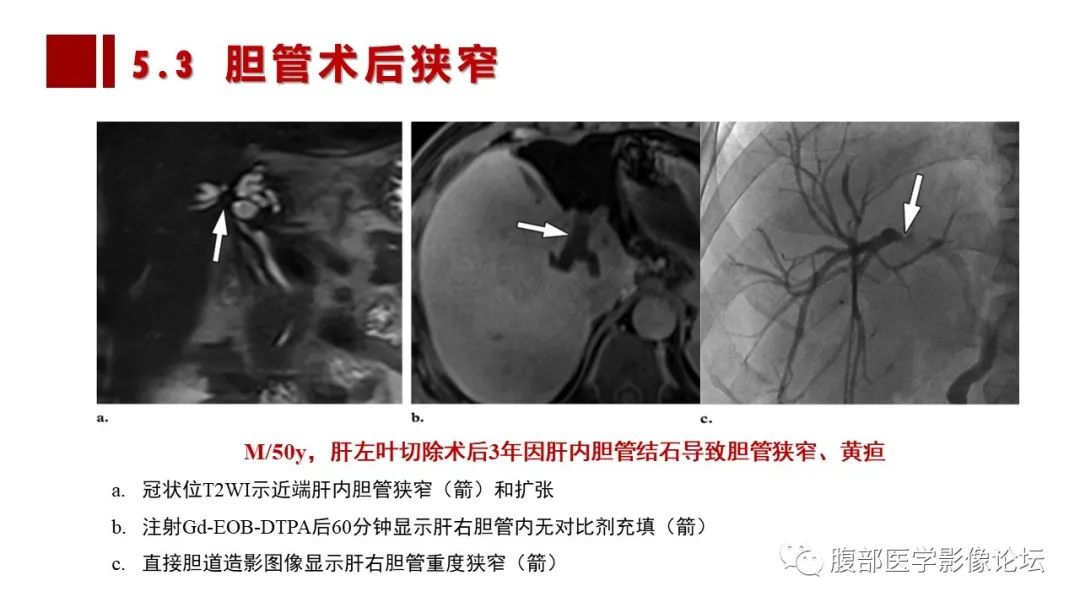 影像PPT - 【PPT】普美显胆管MR成像及其临床应用-53