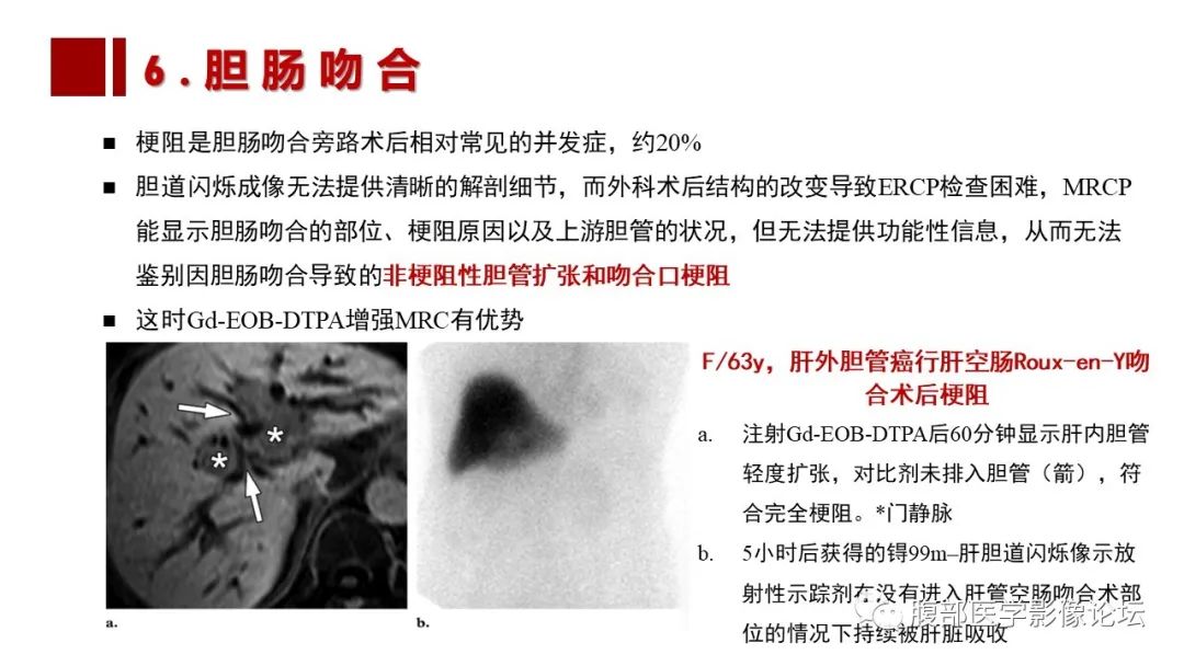 影像PPT - 【PPT】普美显胆管MR成像及其临床应用-54