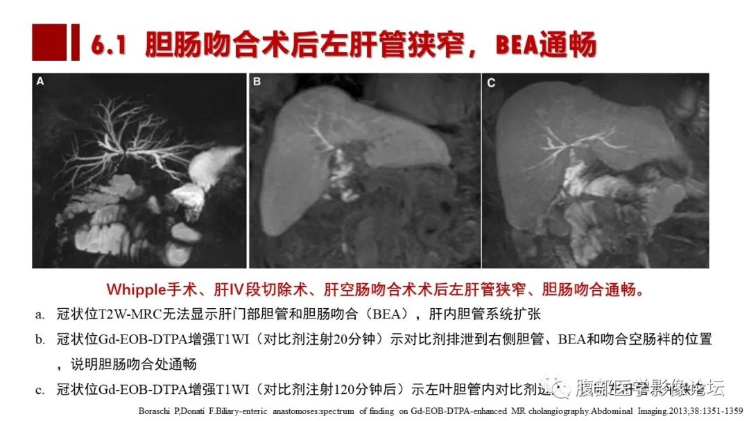 影像PPT - 【PPT】普美显胆管MR成像及其临床应用-55