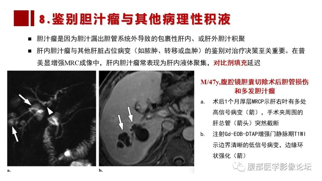 影像PPT - 【PPT】普美显胆管MR成像及其临床应用-57