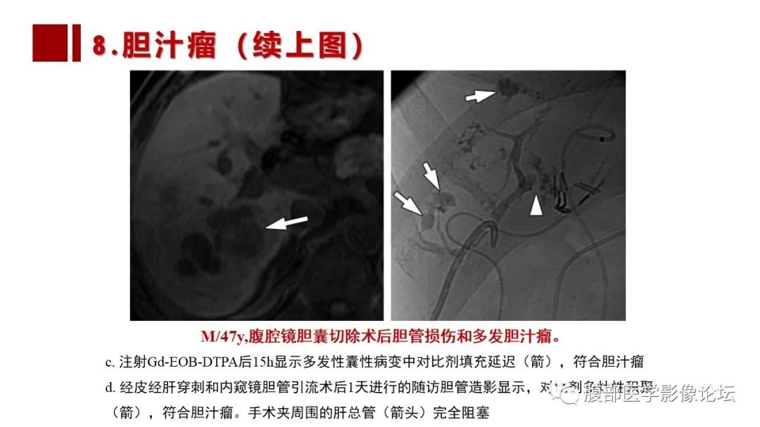 影像PPT - 【PPT】普美显胆管MR成像及其临床应用-58
