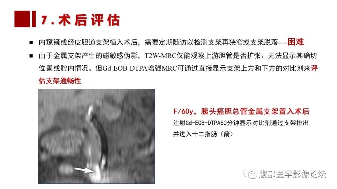 影像PPT - 【PPT】普美显胆管MR成像及其临床应用-56