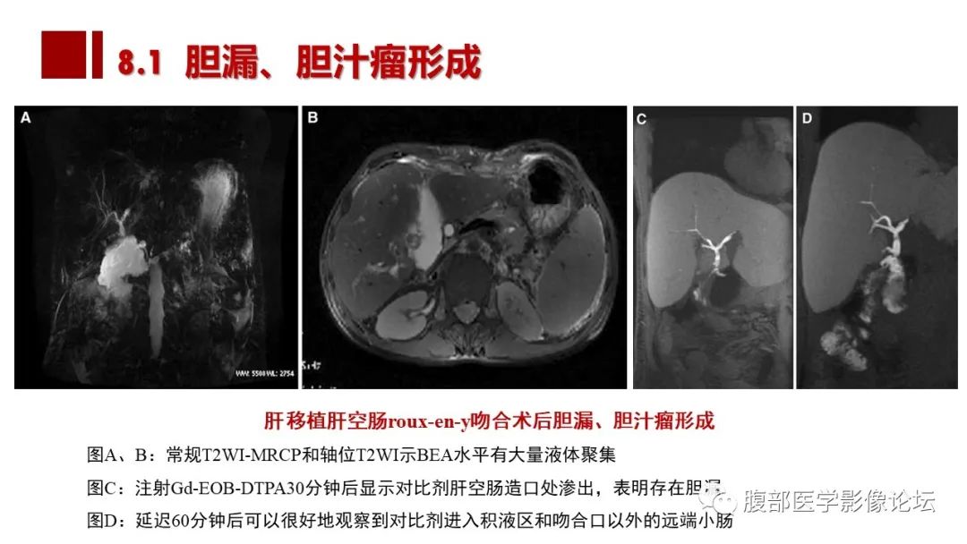 影像PPT - 【PPT】普美显胆管MR成像及其临床应用-59