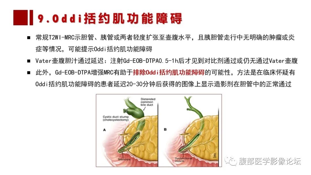 影像PPT - 【PPT】普美显胆管MR成像及其临床应用-61