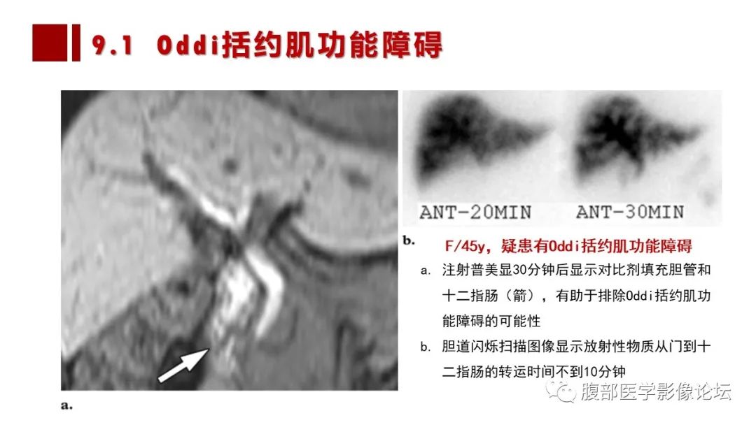 影像PPT - 【PPT】普美显胆管MR成像及其临床应用-62