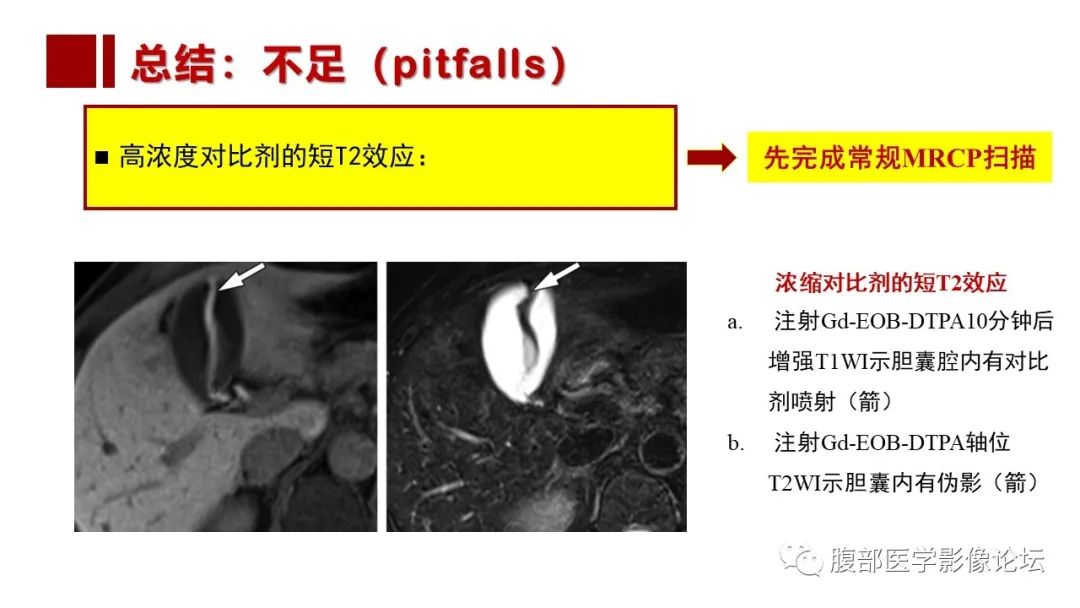 影像PPT - 【PPT】普美显胆管MR成像及其临床应用-66