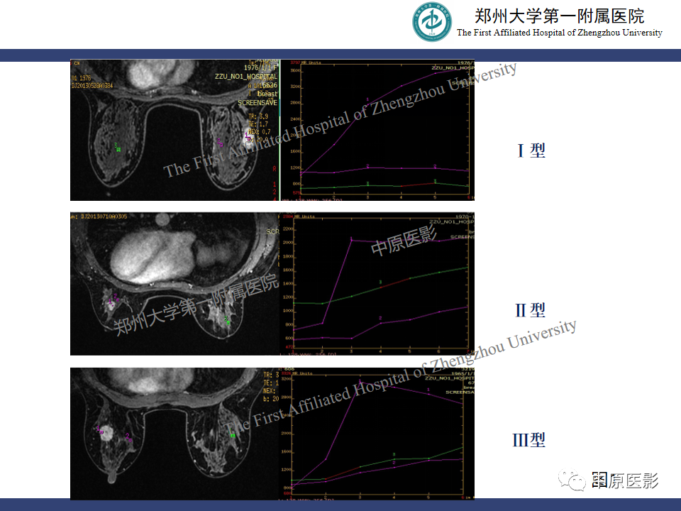 影像PPT - 【PPT】MRI对乳腺良恶性疾病的鉴别诊断-14