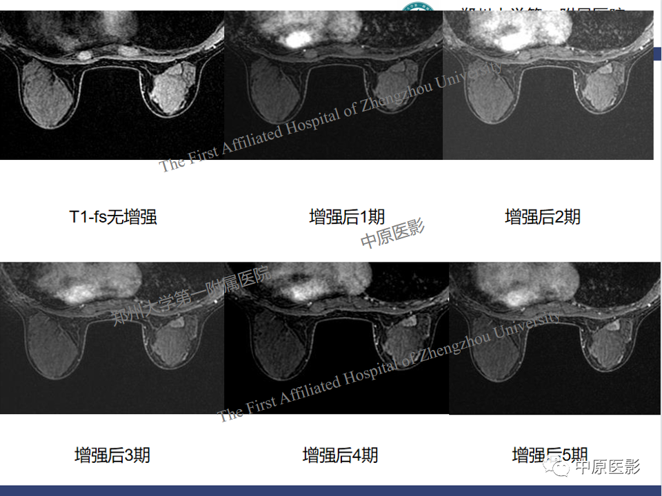 影像PPT - 【PPT】MRI对乳腺良恶性疾病的鉴别诊断-18