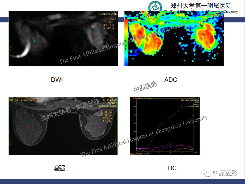 影像PPT - 【PPT】MRI对乳腺良恶性疾病的鉴别诊断-19