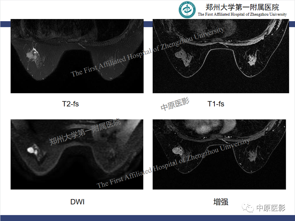 影像PPT - 【PPT】MRI对乳腺良恶性疾病的鉴别诊断-22