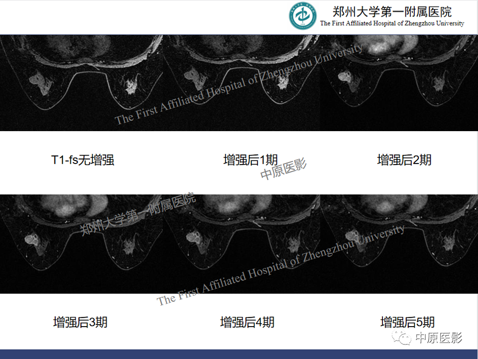 影像PPT - 【PPT】MRI对乳腺良恶性疾病的鉴别诊断-23