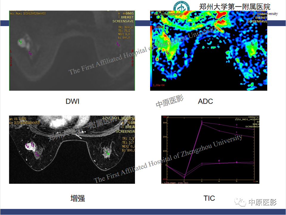 影像PPT - 【PPT】MRI对乳腺良恶性疾病的鉴别诊断-24