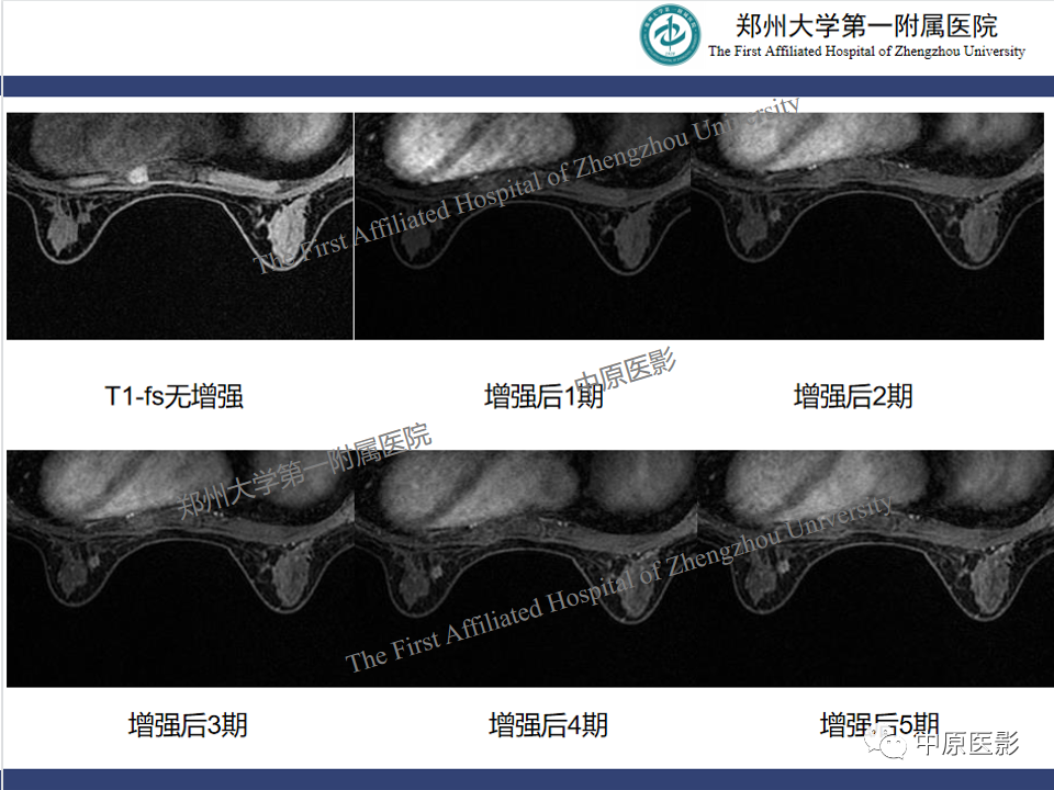影像PPT - 【PPT】MRI对乳腺良恶性疾病的鉴别诊断-31