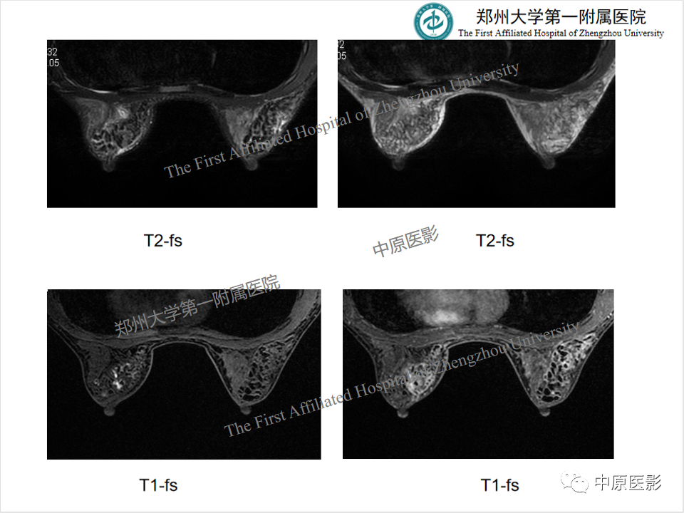 影像PPT - 【PPT】MRI对乳腺良恶性疾病的鉴别诊断-35