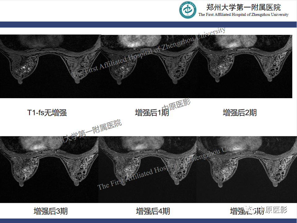 影像PPT - 【PPT】MRI对乳腺良恶性疾病的鉴别诊断-36