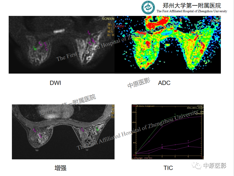 影像PPT - 【PPT】MRI对乳腺良恶性疾病的鉴别诊断-37