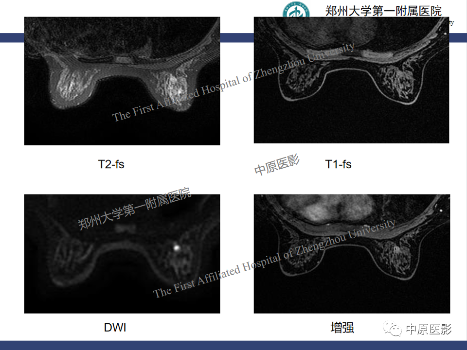 影像PPT - 【PPT】MRI对乳腺良恶性疾病的鉴别诊断-40