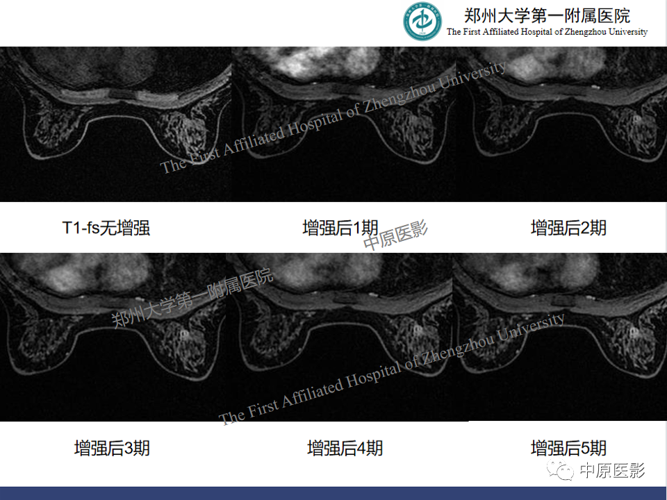 影像PPT - 【PPT】MRI对乳腺良恶性疾病的鉴别诊断-41