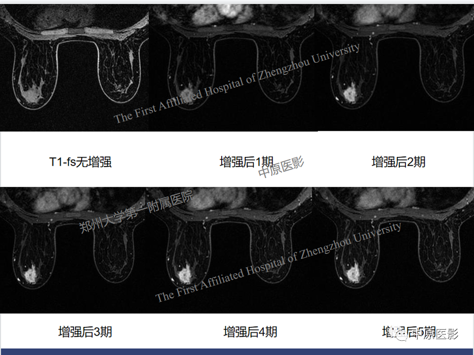 影像PPT - 【PPT】MRI对乳腺良恶性疾病的鉴别诊断-47