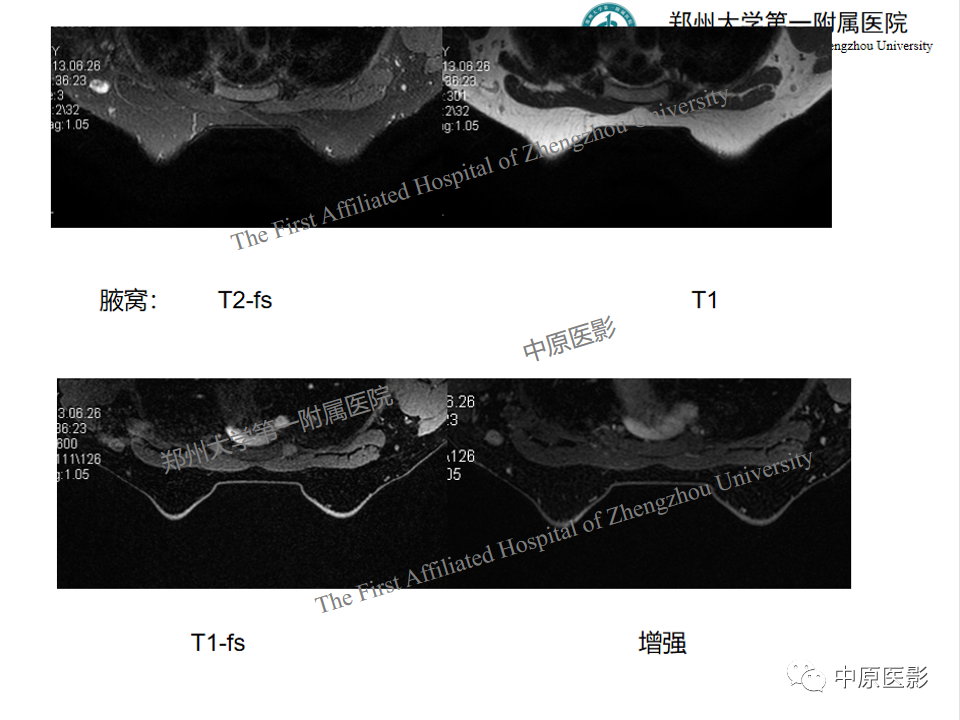 影像PPT - 【PPT】MRI对乳腺良恶性疾病的鉴别诊断-49