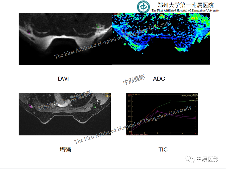 影像PPT - 【PPT】MRI对乳腺良恶性疾病的鉴别诊断-50
