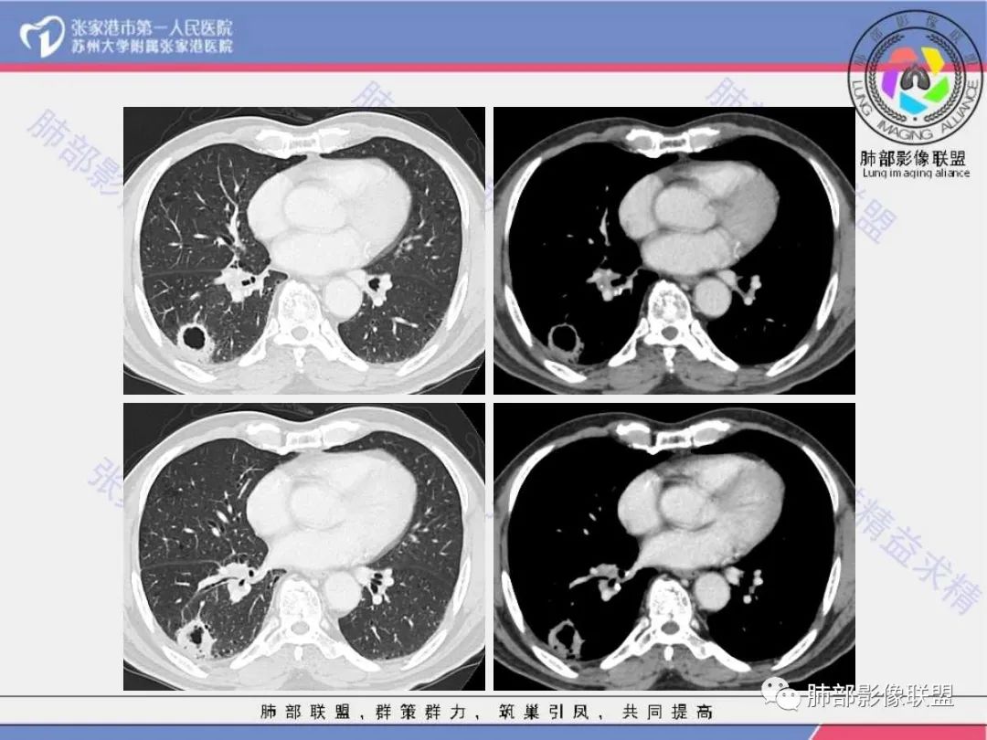影像PPT - 【病例】 这例肺部空洞性病变影像分析应该读一读-12 影像PPT - 【病例】 这例肺部空洞性病变影像分析应该读一读-12